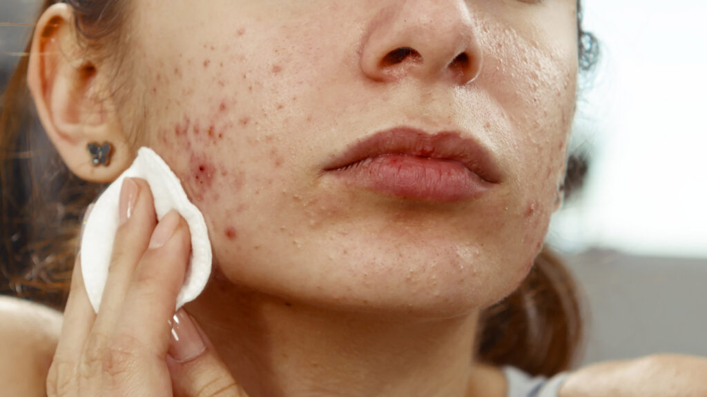 Close-up of a young woman with acne wiping her cheek with a cotton pad, showing inflamed pimples and skin texture.