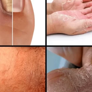 Dry Skin and Peeling Examples on Hands, Feet, and Body Close-up images showing different types of dry and flaky skin on hands, feet, and body.