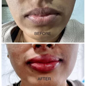 Lip Enhancement Results – Before & After | Skin MD & Hair Clinic Pune Before and after lip enhancement treatment showing improved lip color, shape, and definition.