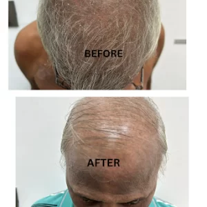 Before and after hair restoration treatment showing visible improvement in scalp coverage at Skin MD & Hair Clinic, Pune. Before and after hair restoration treatment showing visible improvement in scalp coverage at Skin MD & Hair Clinic, Pune.