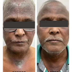 Facial Skin Transformation – Before & After | Skin MD & Hair Clinic Pune Before and after facial skin treatment showing clear improvement in skin texture and complexion at Skin MD & Hair Clinic, Pune.