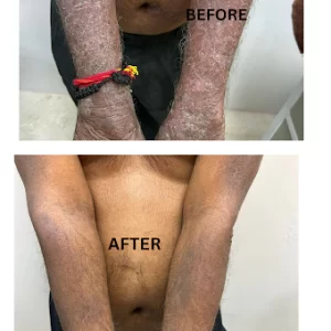 Skin Treatment Results – Before & After | Skin MD & Hair Clinic Pune Before and after treatment for severe skin condition on arms at Skin MD & Hair Clinic, Pune.