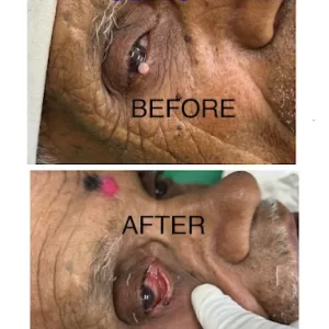 Eye Growth Removal – Before & After Results | Skin MD & Hair Clinic Pune Before and after removal of an eye growth showing clear improvement at Skin MD & Hair Clinic, Pune.