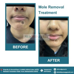 Mole Removal Mole Removal Treatment – Before and After Results | SkinMD & Hair Pune