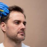 Doctor performing hair transplant procedure with follicle implantation on scalp